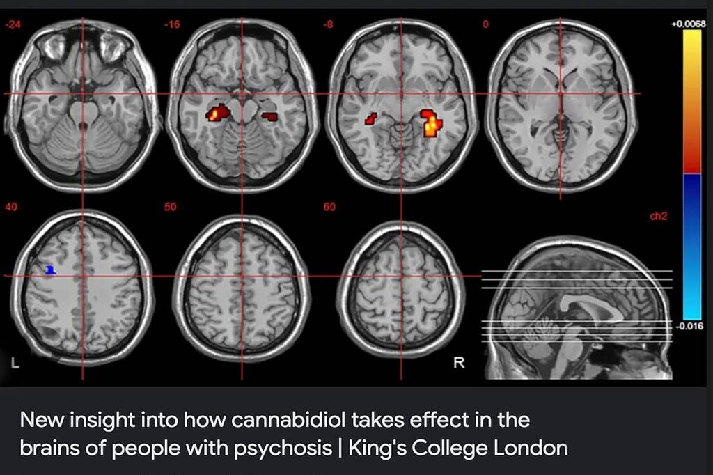 Escáner cerebral que muestra el impacto del CBD en la percepción del dolor.